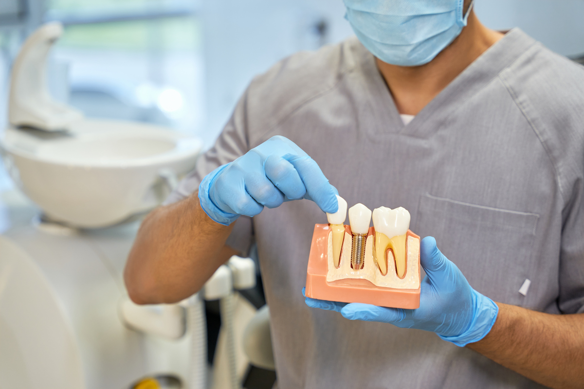 Wszystko co musisz wiedzieć o uzupełnieniu braków w uzębieniu metodą implantu